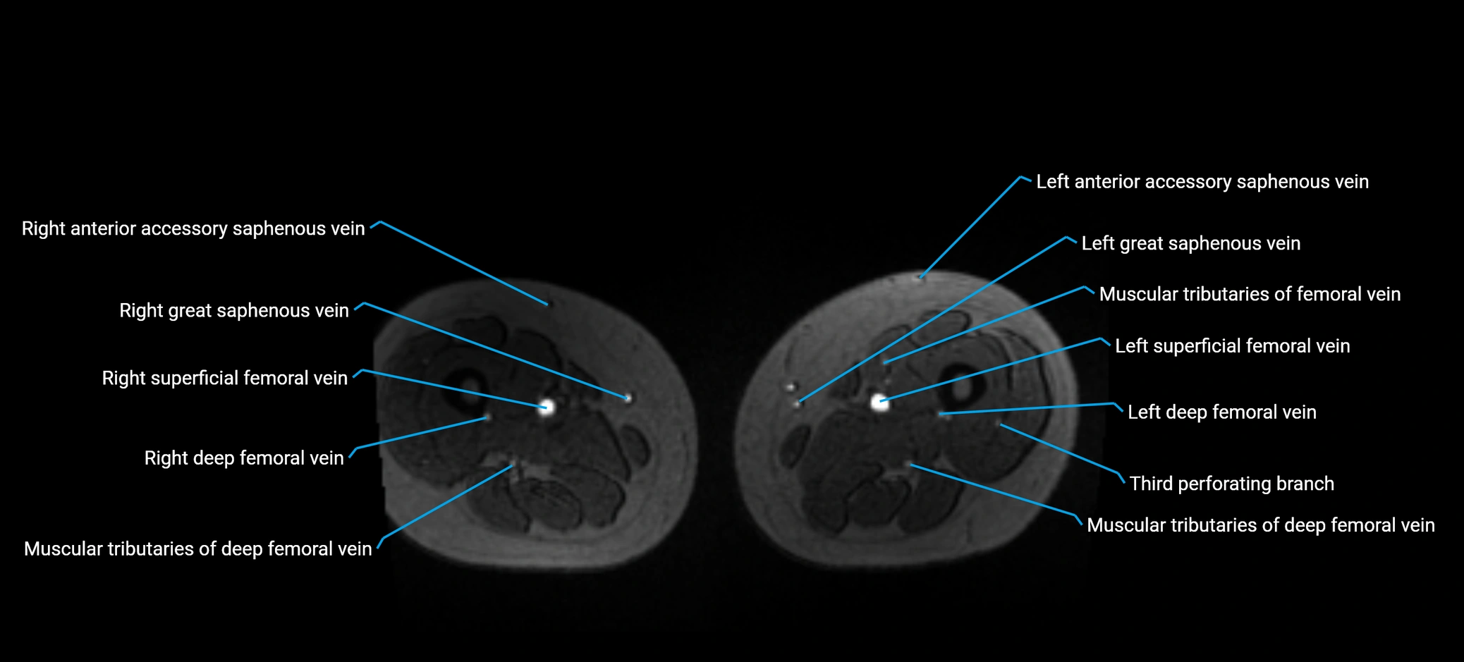 MRV abdomen pelvis & lower limb axial cross sectional anatomy labelled MRI image 279 (1).webp
